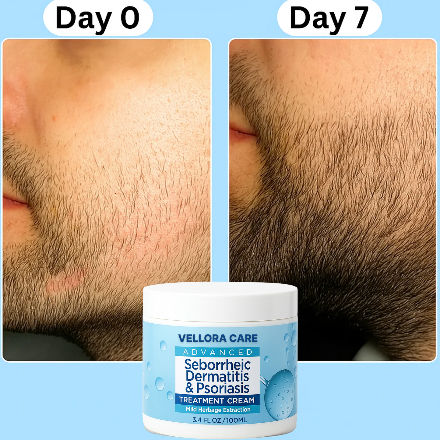 Beard Relief Cream